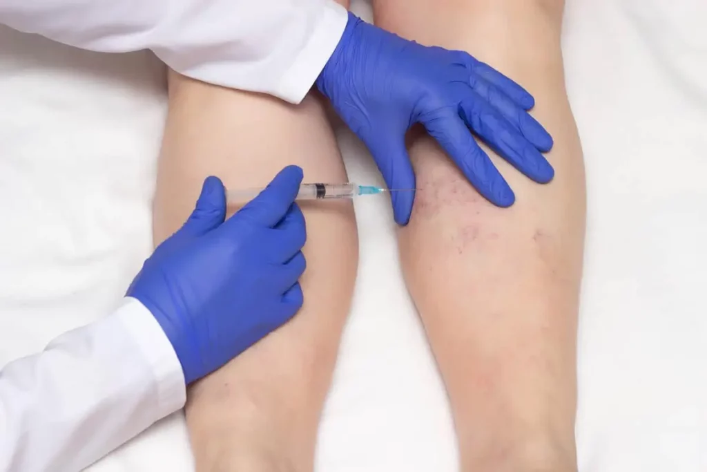 Sclerotherapy by Arcanum Aesthetics in Tampa FL