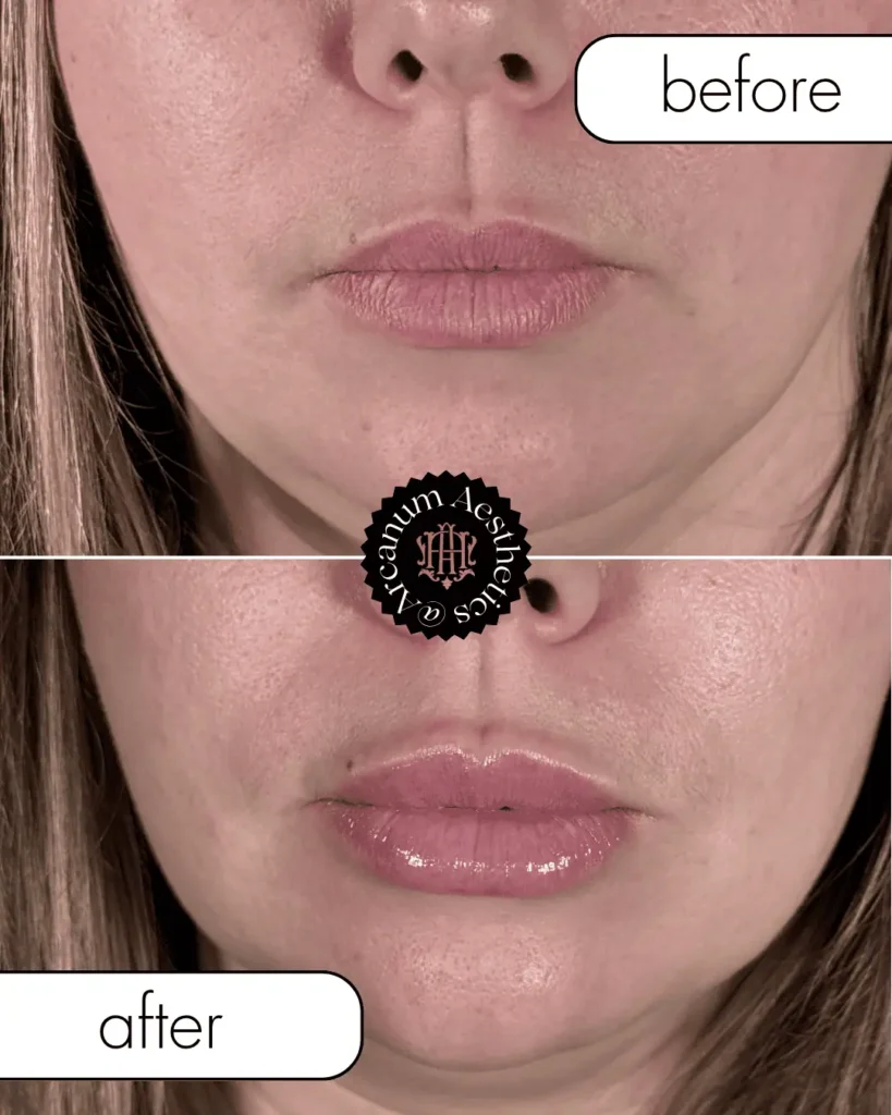 filler Before and After 1