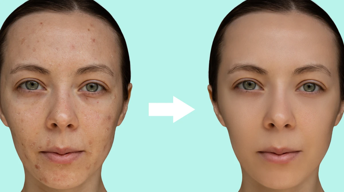 Before and after results of Chemical Peel Treatment - Image 1