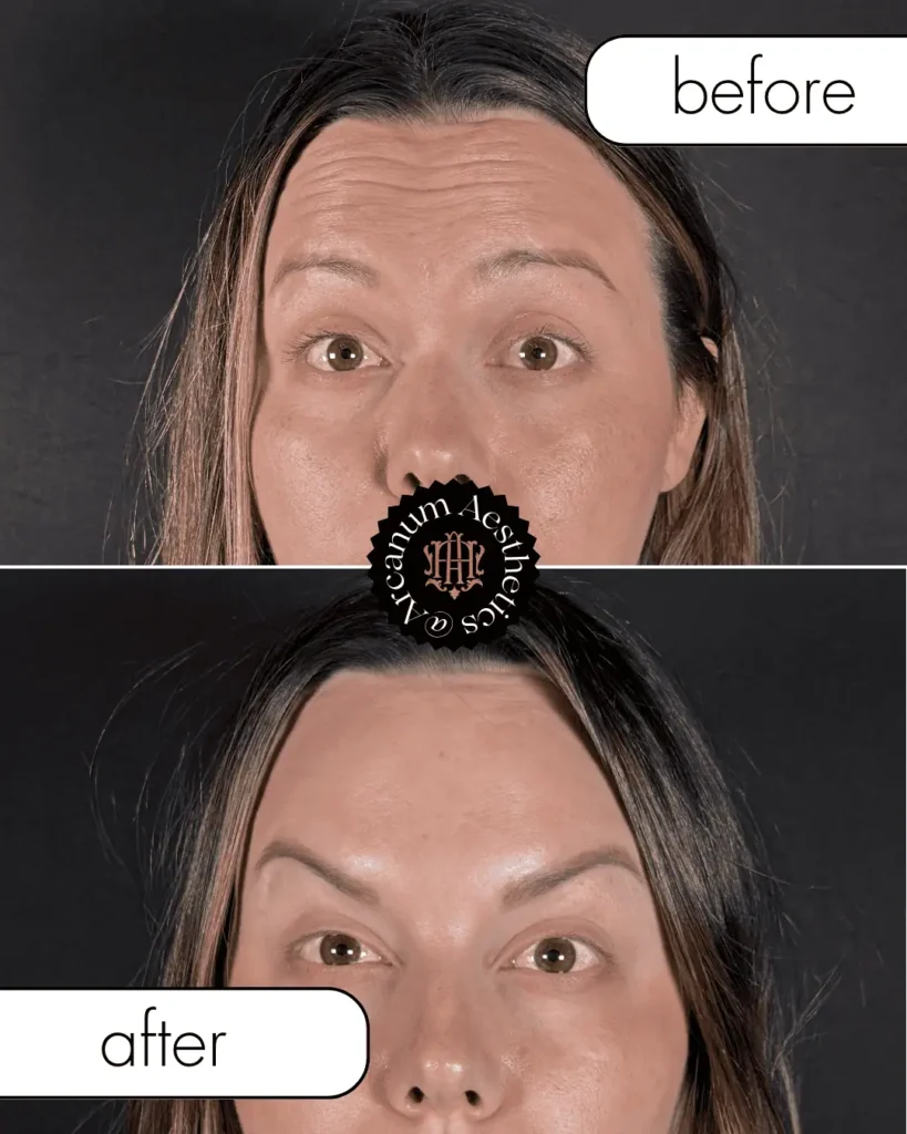 Before and after Result of wrinkle relaxer treatment in Tampa, FL