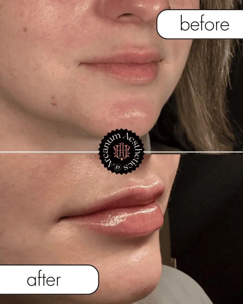 filler Before and After 2